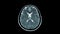 Magnetic Resonance AngiographyMRAof the brain