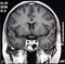 Magnetic Resonance Of Brain, MR