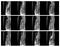 Magnetic resonance image of human spine