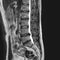 magnetic resonance image - vertebrae of spine with one herniated disc that presses on the spinal cord