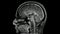 Magnetic resonance  images of the brain MRI brain sagittal post contrast sequence