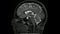 Magnetic resonance  images of the brain MRI brain sagittal T2 weighted sequence