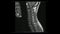 Magnetic Resonance images of Cervical spine sagittal T1-weighted images in Cine mode