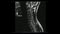 Magnetic Resonance images of Cervical spine sagittal T2-weighted images in Cine mode