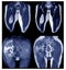 Magnetic Resonance Imaging collection images with a lump in the hip area