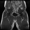 Magnetic resonance imaging of the male hip. Visible changes in osteoarthritis in the right hip