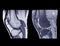 Magnetic resonance imaging or MRI knee comparison sagittal PDW and TIW view