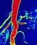 Magnetic resonance renal artery stenosis