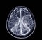 Magnetic resonance venographyMRV Brain of veins in human head.Medical image