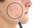 Magnifying young man`s skin with acne problem