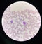 Malaria blood parasite infected red blood cells