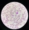 Malaria blood parasite infected red blood cells