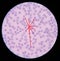 Malaria. Normal and infected red blood cells. Malaria is a disease caused by a parasite called Plasmodium that is spread to human
