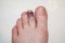 Male adult left foot with stubbed and badly bruised index toe