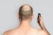 Male alopecia. A man with a receding hairline is holding an electric razor. Rear view. Shoulder-length view. Gray background. Copy