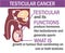 A Male anatomy of Testicular Cancer illustration. Testicular Cancer infographics.