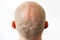 Male bald flaky head with dandruff close-up, back view. White background. The concept of psoriasis and skin problems