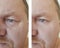 Male eyes wrinkles bloating before  after procedures