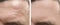 Male face wrinkles removal forehead before and after treatment effect