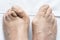 Male feet together with big bunions and hammer toes