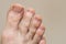 Male foot with symptoms of fungal nail plate. Nails on man`s legs. Caucasian foot with dirty and nails
