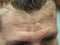 Male forehead stained during hair coloring.