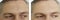 Male forehead wrinkles eyes, bloating effect before and after removal cosmetology procedures