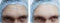 Male forehead  wrinkles before and after treatment