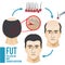 Male hair loss treatment medical vector infographic