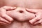 Male hands hold subcutaneous fat on the hairy belly