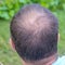 Male head with thinning hair or alopecia