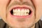 Male mouth, tooth grin