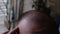 Male pattern baldness. The man touches the bald patches on his head