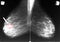 Mammogram with breast cancer