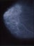 mammography of the female breast