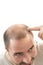 Man alopecia baldness hair loss isolated