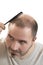Man alopecia baldness hair loss isolated