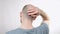 A man with alopecia is stroking his head with his hand. Rear view. The concept of baldness and health problems