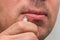 Man applying ointment to herpes on lips for treatment