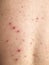 Man back having varicella blister or chickenpox