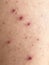 Man back having varicella blister or chickenpox