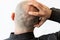 A man in a black shirt is holding his bald head covered with seborrheic dermatitis and dandruff. The concept of skin