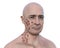 A man with cutaneous blastomycosis, 3D illustration