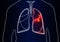 Man with diseased lungs on background. Illustration
