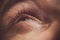 A man drips open human eye with bright red arteries drops to improve vision close up. irritation and redness of the eyeball.