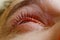 A man drips open human eye with bright red arteries drops to improve vision close up. irritation and redness of the eyeball.