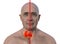 A man with enlarged thyroid gland, 3D illustration