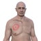 A man with erythema migrans, a characteristic rash of Lyme disease caused by Borrelia burgdorferi, 3D illustration