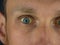 Man eyes obstructive Jaundice yellow discoloration Real people liver dysfunction icteruswith cirrhosis hepatitis symptom