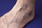 A man foot with a mesh of dilated varicose veins stands on a blue background